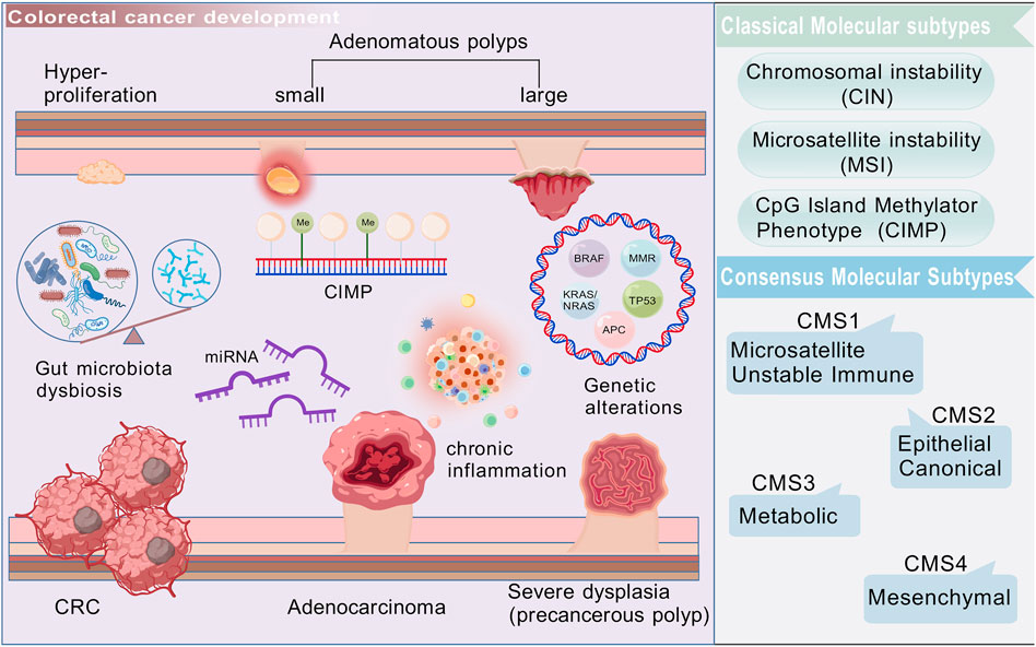 Diagram illustrating colorectal cancer development, showing hyper-proliferation, adenomatous polyps, dysbiosis, inflammation, and genetic alterations. Includes lists of classical molecular subtypes and consensus molecular subtypes like CIN, MSI, CIMP, CMS1-4.
