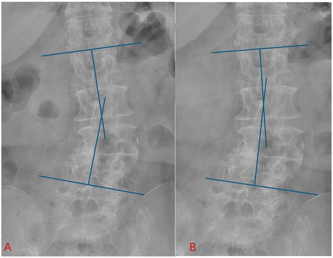 Preoperative and postoperative axial T2-weighted MRI scans. (A) Preoperative image showing a herniated intervertebral disc (red arrow) compressing the nerve root. (B) Postoperative follow-up demonstrating adequate decompression, with the nerve root clearly released and no residual compression at the surgical level.