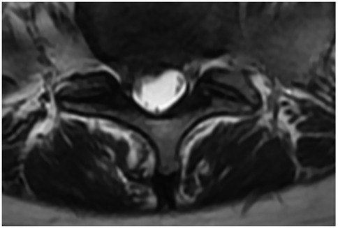 Preoperative and postoperative axial T2-weighted MRI scans. (A) Preoperative image showing a herniated intervertebral disc (red arrow) compressing the nerve root. (B) Postoperative follow-up demonstrating adequate decompression, with the nerve root clearly released and no residual compression at the surgical level.