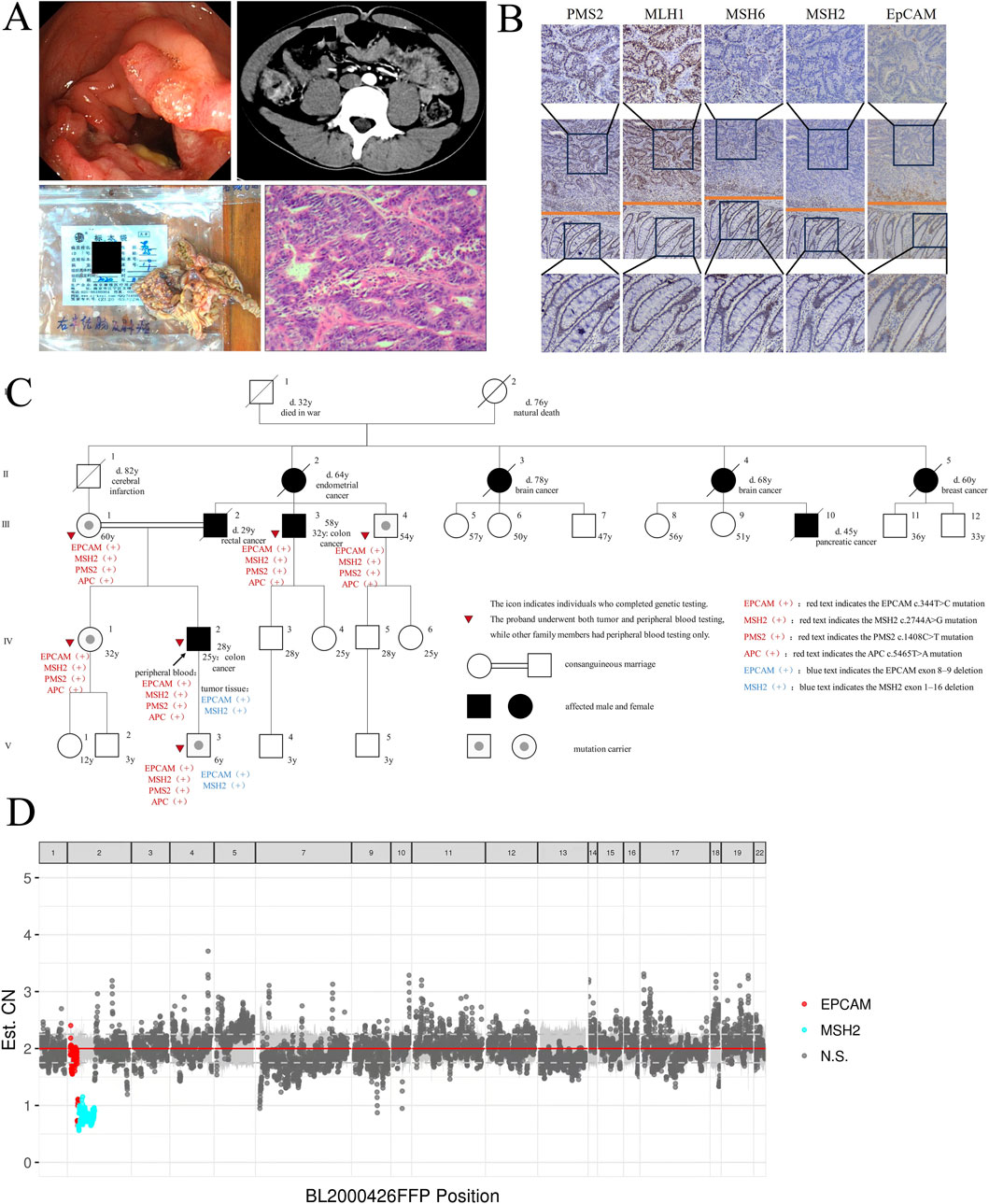 Composite image consisting of four panels labeled A to D. Panel A shows endoscopic and CT images of the colon, a surgical specimen, and histological slides. Panel B depicts immunohistochemical staining for PMS2, MLH1, MSH6, MSH2, and EpCAM. Panel C presents a family pedigree chart indicating genetic testing results and cancer histories. Panel D is a graph displaying estimated copy numbers for EPCAM, MSH2, and other genetic markers across different chromosomal positions.