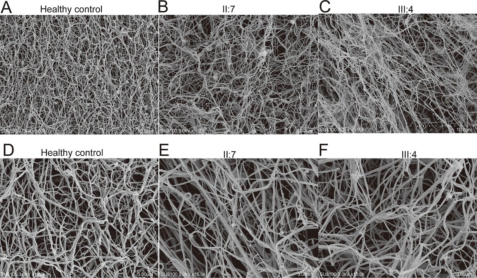 Series of six grayscale electron microscope images showing fibrous networks. Images A and D labeled "Healthy control" depict dense interwoven fibers. Images B and E labeled "II:7" show a similar but slightly less dense structure. Images C and F labeled "III:4" display more irregular and sparser fibers compared to the control. All images have scale bars indicating magnification levels.