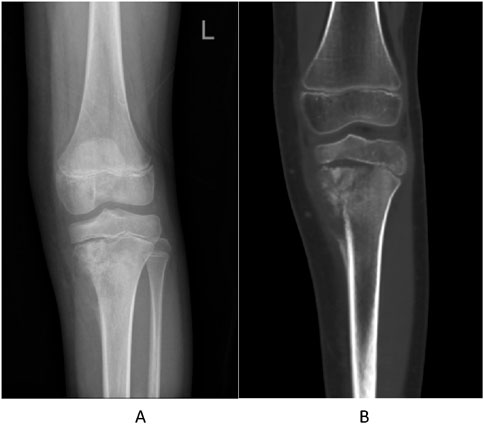 X-ray images show a side-by-side comparison of a knee joint. Image A displays a standard X-ray with clear bone structures, including the femur, tibia, and knee joint. Image B is a CT scan of the same area, highlighting internal bone detail with different contrast levels. Both images focus on the left knee.