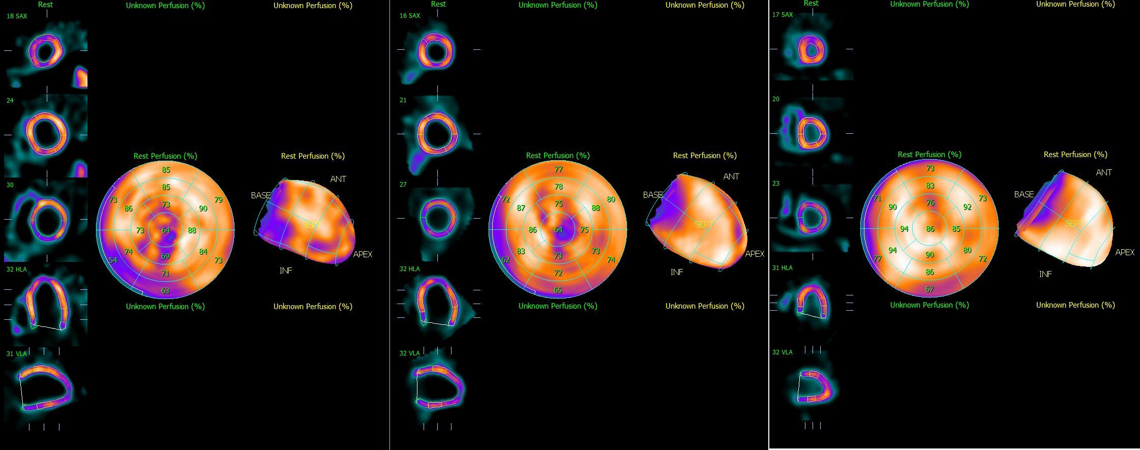 Three panels display heart perfusion imaging. Each panel features cross-sectional scans and polar maps, indicating rest perfusion percentages. Gradient colors represent varying levels of perfusion, with annotations such as SAX, HLA, and VLA providing orientation. The polar maps highlight sections labeled ANT, INF, SEPT, BASE, and APEX, showing numeric perfusion data.