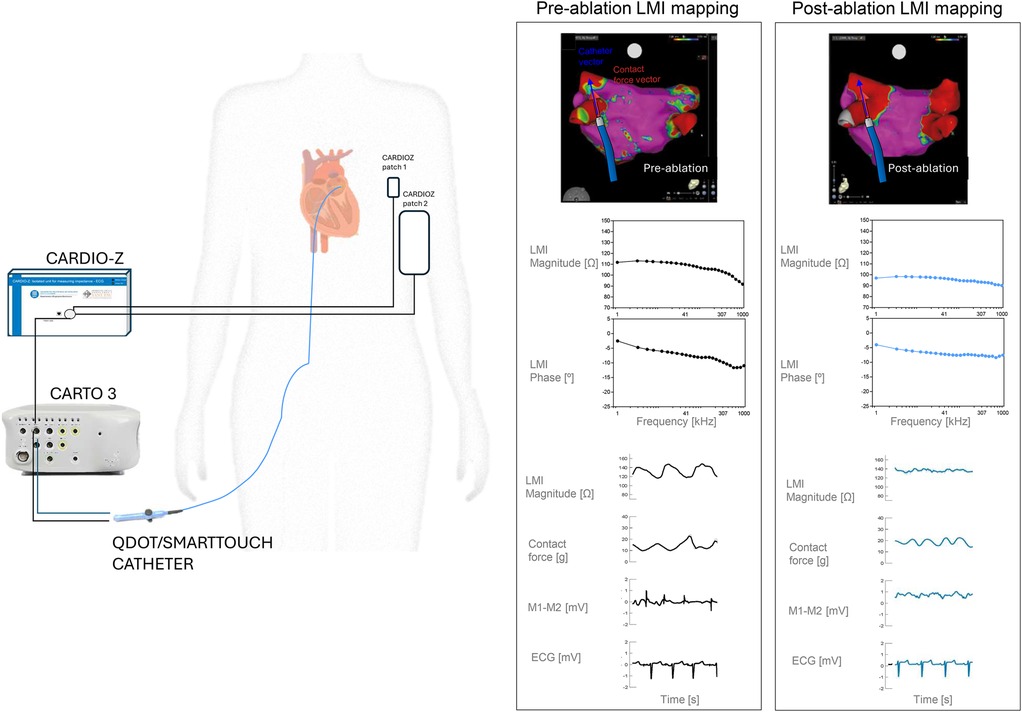 Diagram depicting a medical setup involving CARDIO-Z and CARTO 3 systems connected to a QDOT/SMARTTOUCH catheter inserted in a human body. On the right, there are pre-ablation and post-ablation LMI mapping charts showing comparisons in LMI magnitude, phase, contact force, and ECG readings over time. Pre-ablation readings are in black, and post-ablation readings are in blue.