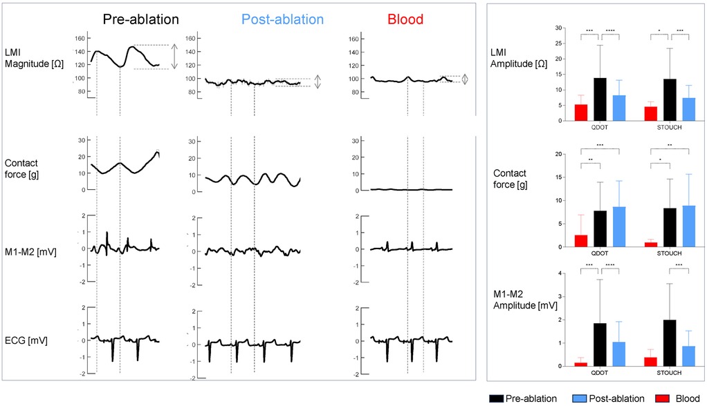 A series of graphs comparing a representative example of the time evolution of LMI magnitude, contact force, local bipolar electrogram and ECG of pre- and post-abaltion and blood. Bar chart on the right shows the mean values of LMI magnitude,contact force, local bipolar electrogram opre- and post-abaltion and blood.