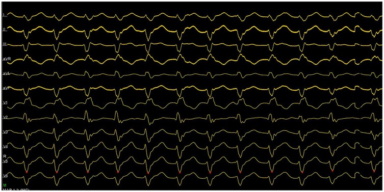 Electrocardiogram (ECG) displaying multiple leads with yellow waveforms on a black background. The leads are labeled from top to bottom: I, II, III, aVR, aVL, aVF, V1, V2, V3, V4, V5, and V6, showing distinct patterns for each.