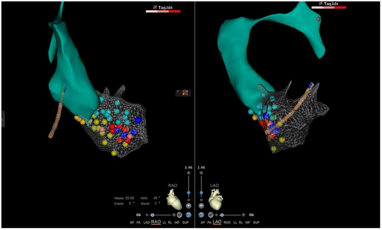 Medical imaging showing two 3D models of the heart, highlighting blood vessels in teal with intricate mesh structures. Colorful dots of red, yellow, and blue indicate specific areas or data points. A catheter-like object is visible, positioned through the mesh.