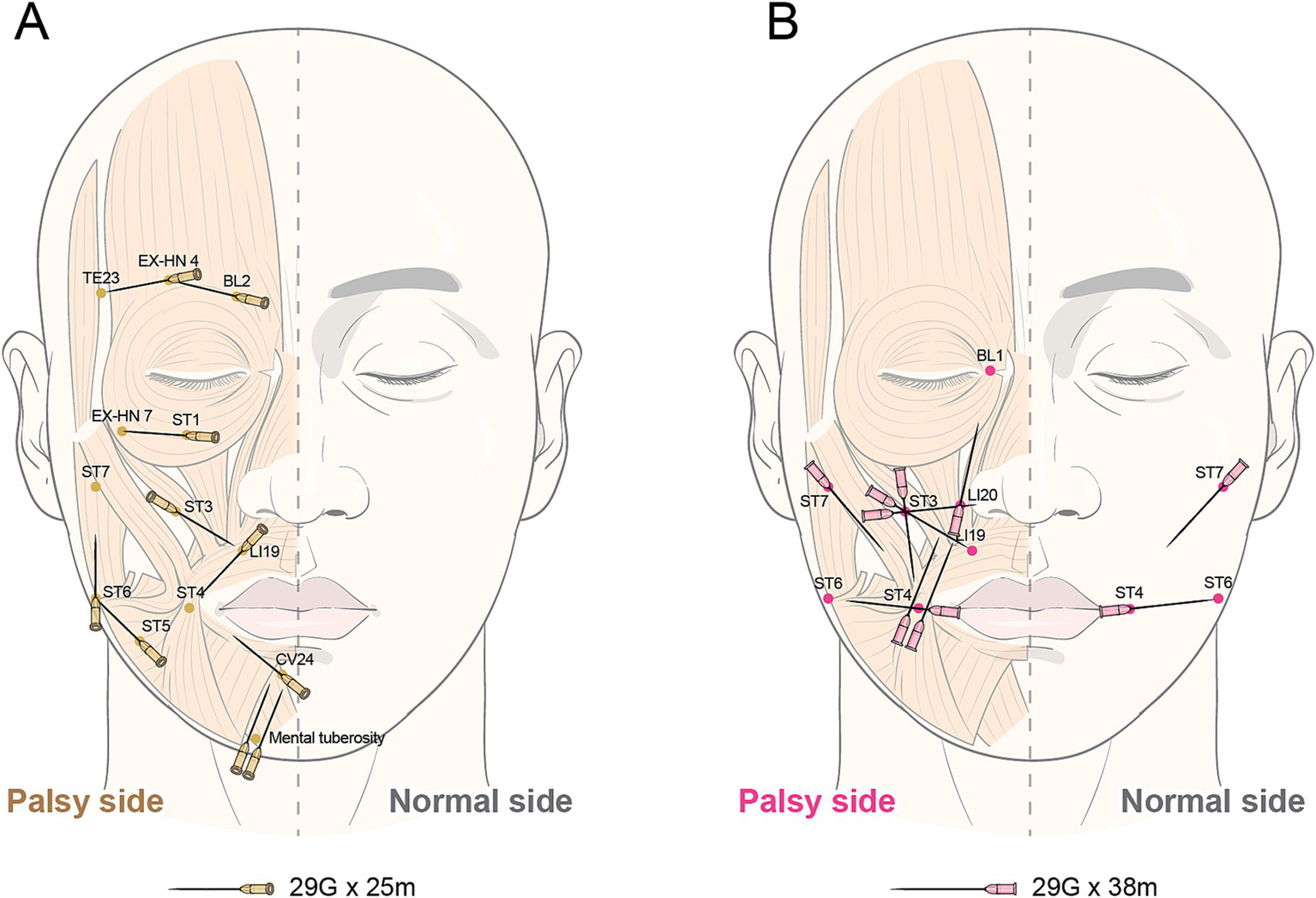 Illustration showing acupuncture points on the face for facial palsy treatment. Panel A displays acupuncture needle placements on the palsy side with yellow dots and labels like TE23 and ST7. Panel B shows similar placements on the palsy side with pink dots and labels such as BL1 and ST3. The normal side of the face is depicted on both panels without any markings.