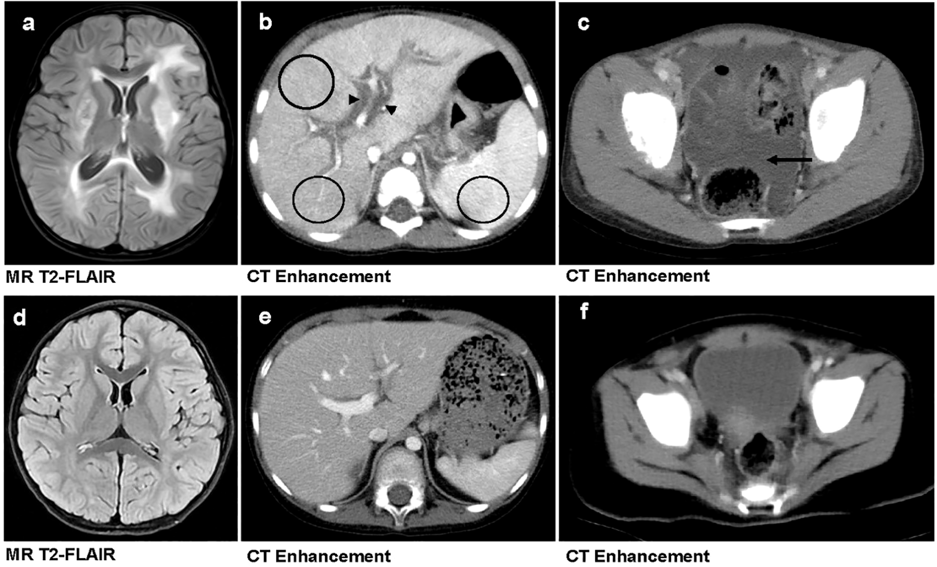 Six-panel medical image showing MRI and CT scans. Panel a: T2-FLAIR MRI of the brain; panel b: CT scan of the abdomen with enhancement, circled areas indicated; panel c: enhanced CT of the pelvis with arrow pointing to a region. Panel d: another T2-FLAIR MRI of the brain; panel e: CT enhancement of the abdomen; panel f: CT enhancement of the pelvis. Each panel represents distinct diagnostic imaging.
