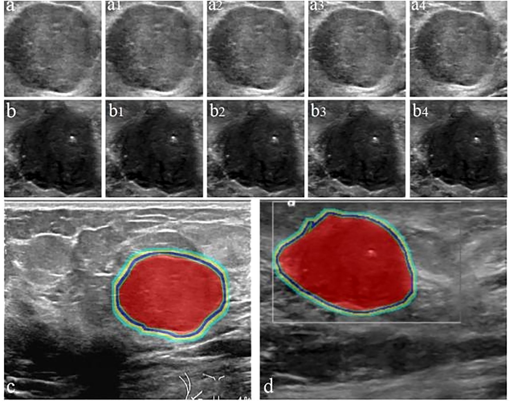 Ultrasound images depicting a mass in sequential views. The top two rows (a1 to a4 and b1 to b4) show grayscale ultrasound images of the mass from different angles. The bottom row includes two larger images (c and d), highlighting the mass with red and blue outlines, indicating its boundaries and possibly differentiating tissue types.