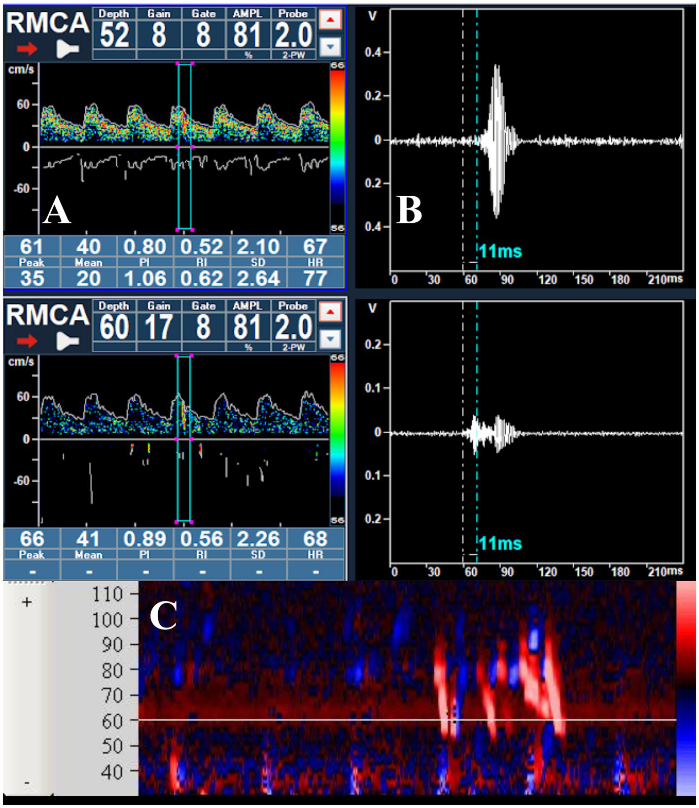 Transcranial Doppler ultrasound images showing three panels labeled A, B, and C. Panel A displays velocity waveforms with peak, mean values, and color spectrum. Panel B shows a waveform with a marked interval of eleven milliseconds. Panel C presents a spectrogram, with red and blue colors indicating varying velocities. Labels and numerical values are visible for detailed analysis.