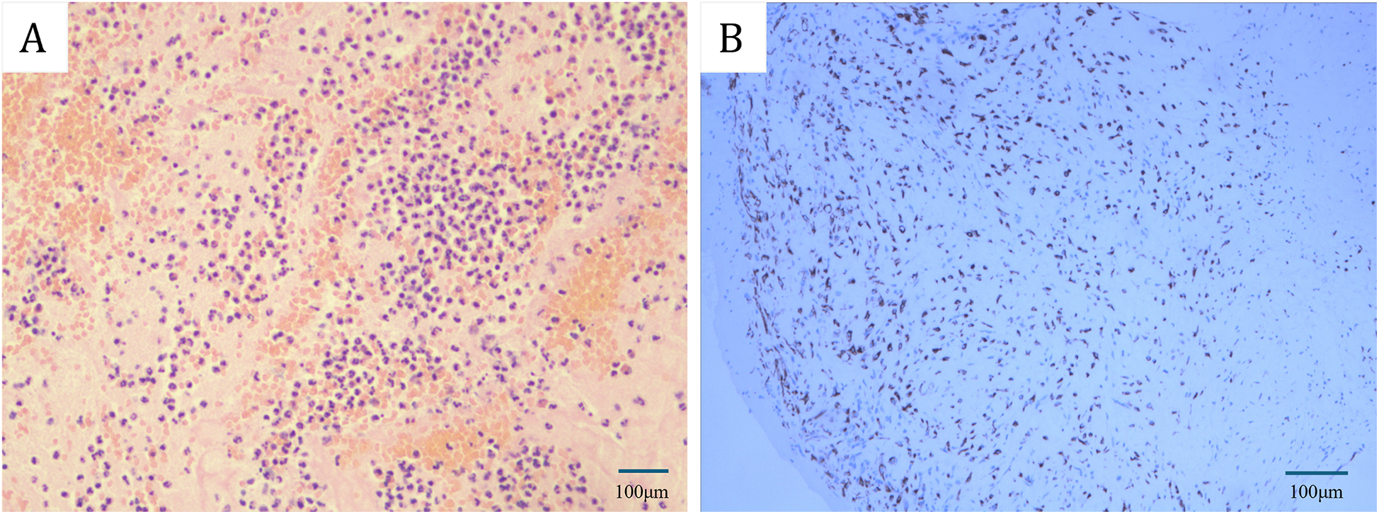 Panel A shows a histological image with numerous dark purple-stained cells scattered on a pink background, indicating concentrated cellular presence. Panel B displays blue-stained tissue with scattered darker elongated cell nuclei, suggesting a different tissue composition. Both images include scale bars indicating one hundred micrometers.