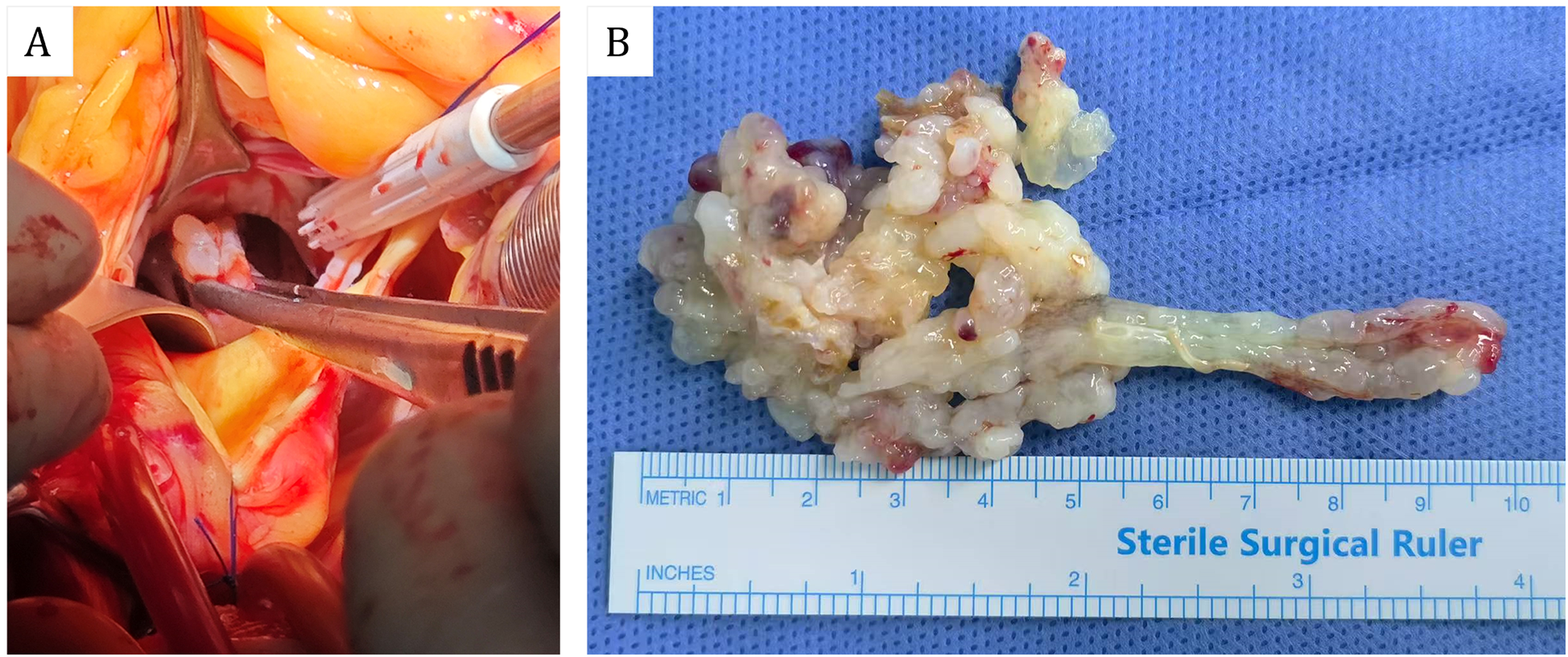 Image A shows surgical instruments working in a blood-rich area during a medical procedure. Image B displays a white, gelatinous mass with red areas next to a ruler on a blue surgical cloth.