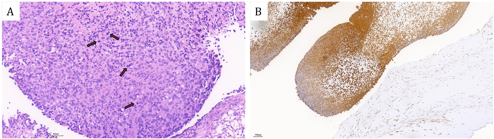 Panel A shows a histological section stained with cells densely packed and colored in shades of purple, with a few red-marked arrows. Panel B displays a tissue section with brown-stained areas, indicating areas of interest, contrasted against lighter unstained regions.