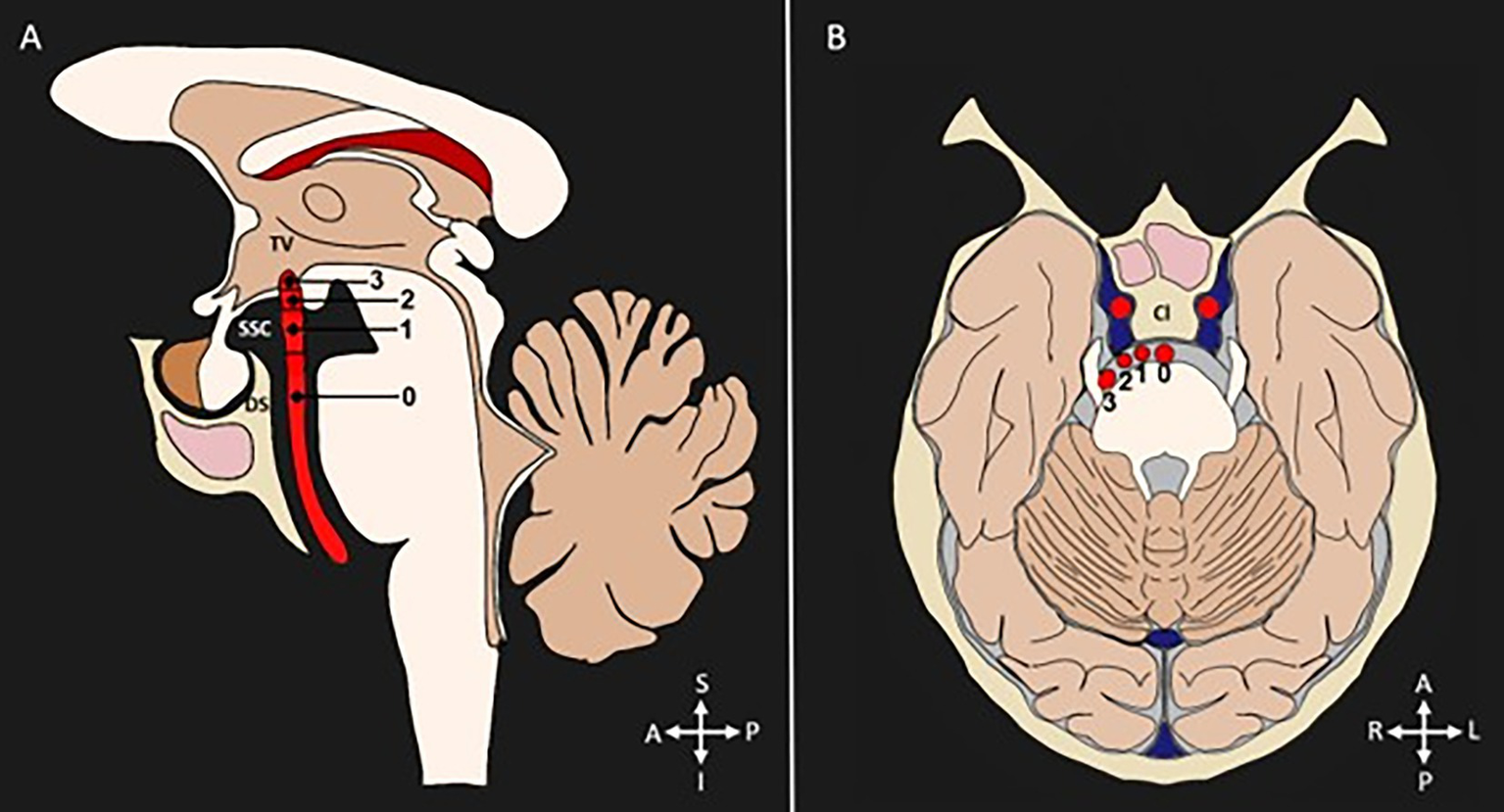 Diagram of a sagittal and cross-section of the brainstem depicting the landmarks of the different levels of bifurcation height and lateral displacement of the basilar artery. Panel A shows a sagittal section with labeled regions including the third ventricle (TV), suprasellar cistern (SSC), and dorsum sellae (DS), and shows the grades of basilar artery bifurcation height, from grade 0, located inferior to the dorsum sella turcica, to grade 3, indenting into the floor of the third ventricle. Panel B shows a cross-section showing the displacements of the basilar artery from grade 0, where the artery is located in the midline, to grade 3, where the artery is located at the level of the cerebellopontine cistern.
