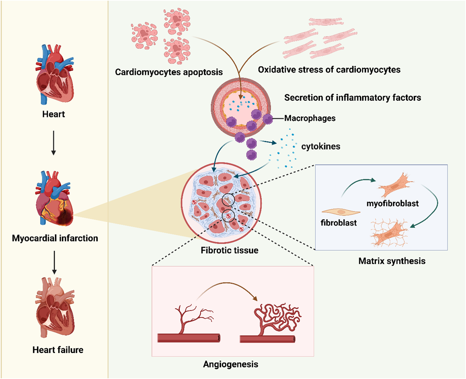 Diagram illustrating the progression from a healthy heart to heart failure. It shows myocardial infarction leading to cardiomyocyte apoptosis, oxidative stress, and the secretion of inflammatory factors by macrophages. This results in fibrotic tissue formation, involving fibroblast to myofibroblast transformation and matrix synthesis, contributing to angiogenesis and ultimately heart failure.