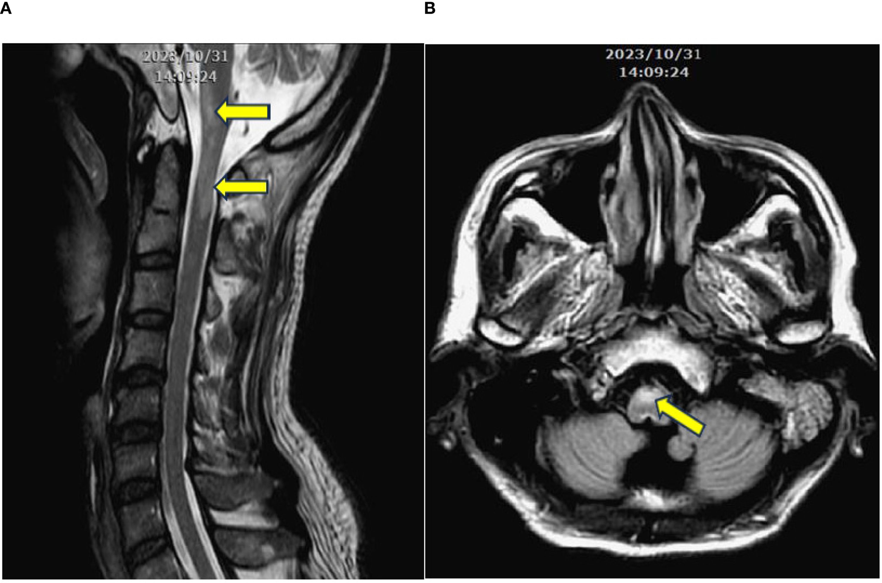MRI scans of the cervical spine. Image A shows a sagittal view with two yellow arrows indicating areas of interest along the spinal cord. Image B is an axial view with a yellow arrow pointing to a specified region in the brainstem area, dated October 31, 2023, at 14:09.