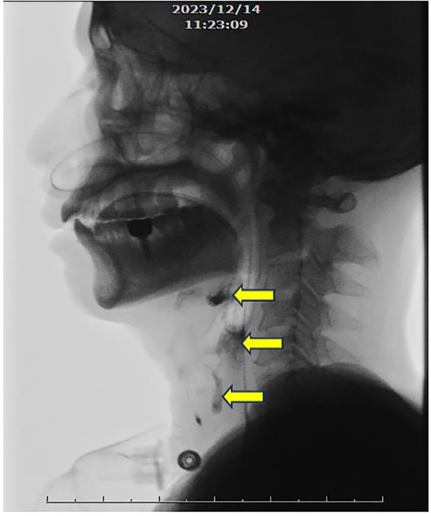 X-ray side profile of a human head and neck. Three yellow arrows point to specific areas along the throat, possibly indicating points of interest or medical concern. The date and time at the top read December 14, 2023, 11:23:09.