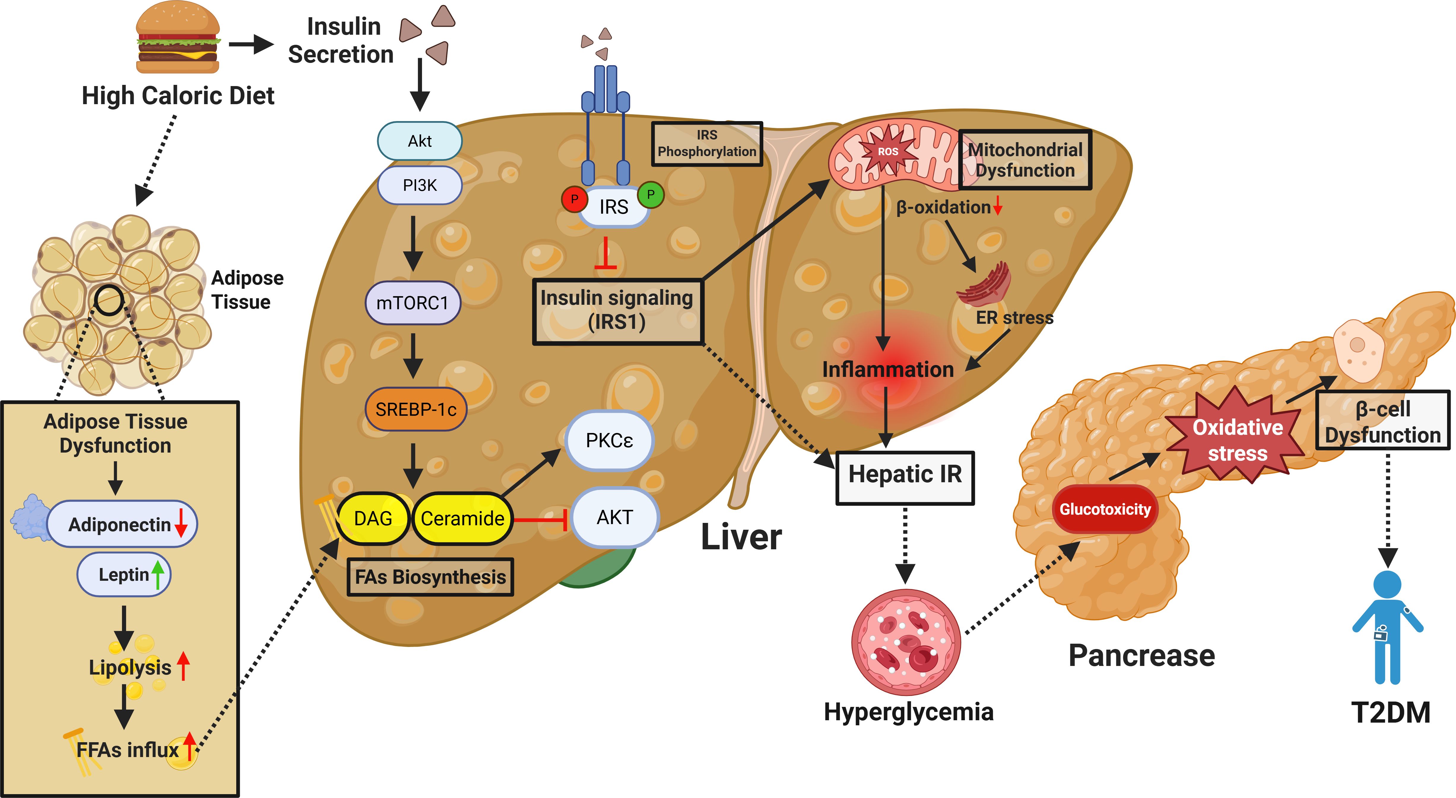 Diagram illustrating metabolic pathways leading to type 2 diabetes mellitus (T2DM). A high-caloric diet causes adipose tissue dysfunction, decreasing adiponectin and increasing lipolysis, leading to free fatty acid influx. In the liver, this disrupts insulin signaling, increases mitochondrial dysfunction, and inflammation. Elevated diacylglycerol (DAG) and ceramide levels contribute to hepatic insulin resistance (IR). In the pancreas, glucotoxicity causes oxidative stress and beta-cell dysfunction, resulting in hyperglycemia and T2DM.