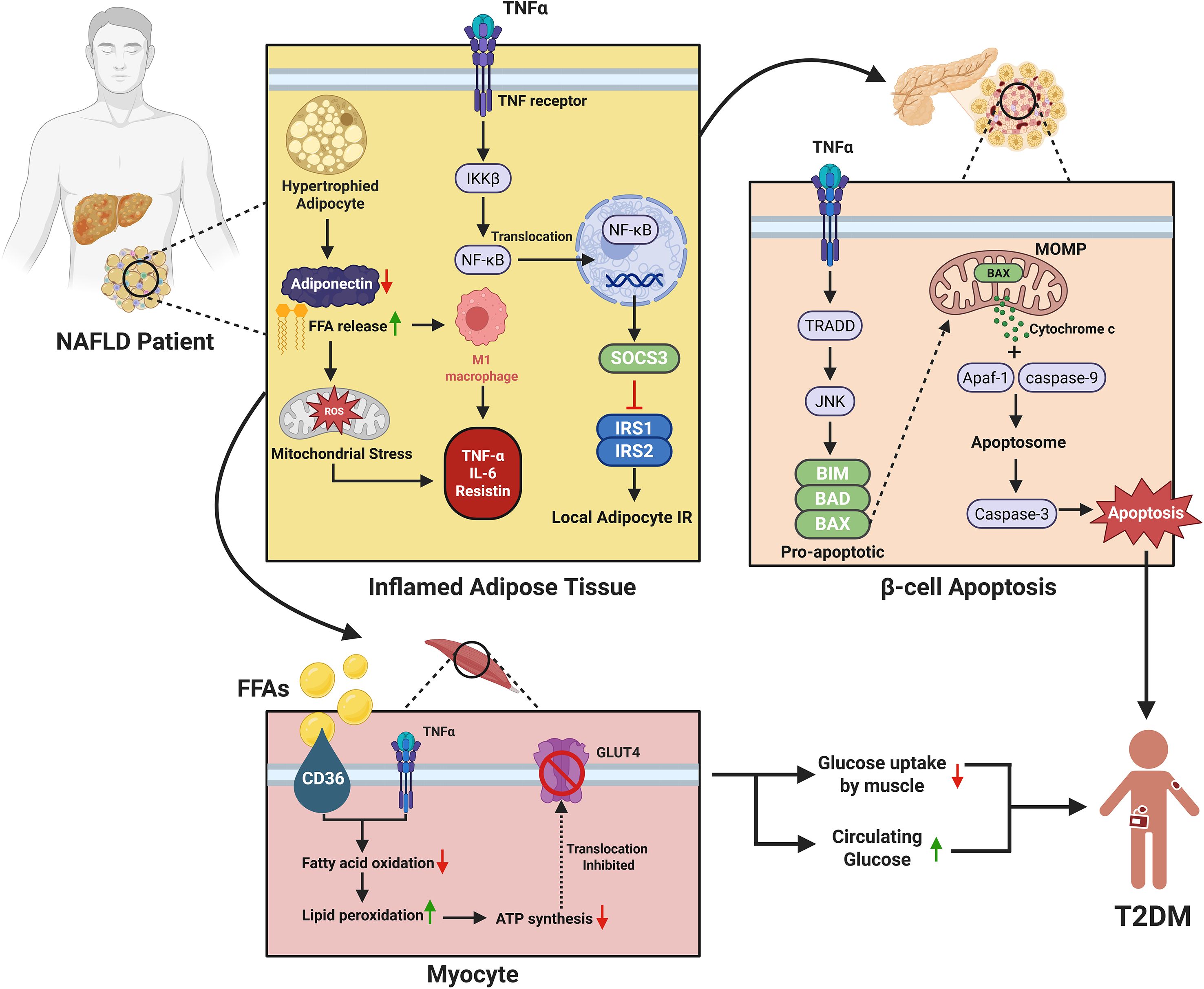 Diagram illustrating the connection between Non-Alcoholic Fatty Liver Disease (NAFLD) and Type 2 Diabetes Mellitus (T2DM). It shows hypertrophied adipocytes leading to mitochondrial stress and inflammation in adipose tissue, causing increased TNF-α, IL-6, and resistin release. This triggers insulin resistance and β-cell apoptosis. Free fatty acids released cause lipid peroxidation and reduced ATP synthesis in myocytes, inhibiting glucose uptake, thus raising circulating glucose levels and contributing to T2DM development.