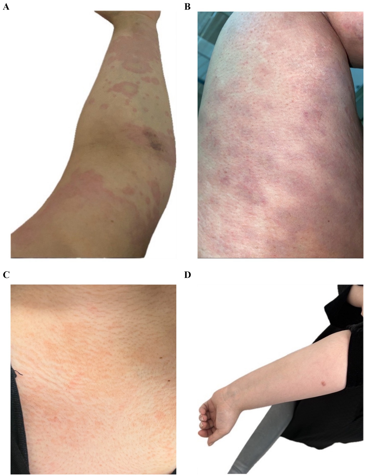 Panel A shows an arm with red, patchy skin. Panel B displays a leg with a similar red, blotchy appearance. Panel C highlights a close-up of skin with mild redness. Panel D reveals an arm with a small, isolated red spot.