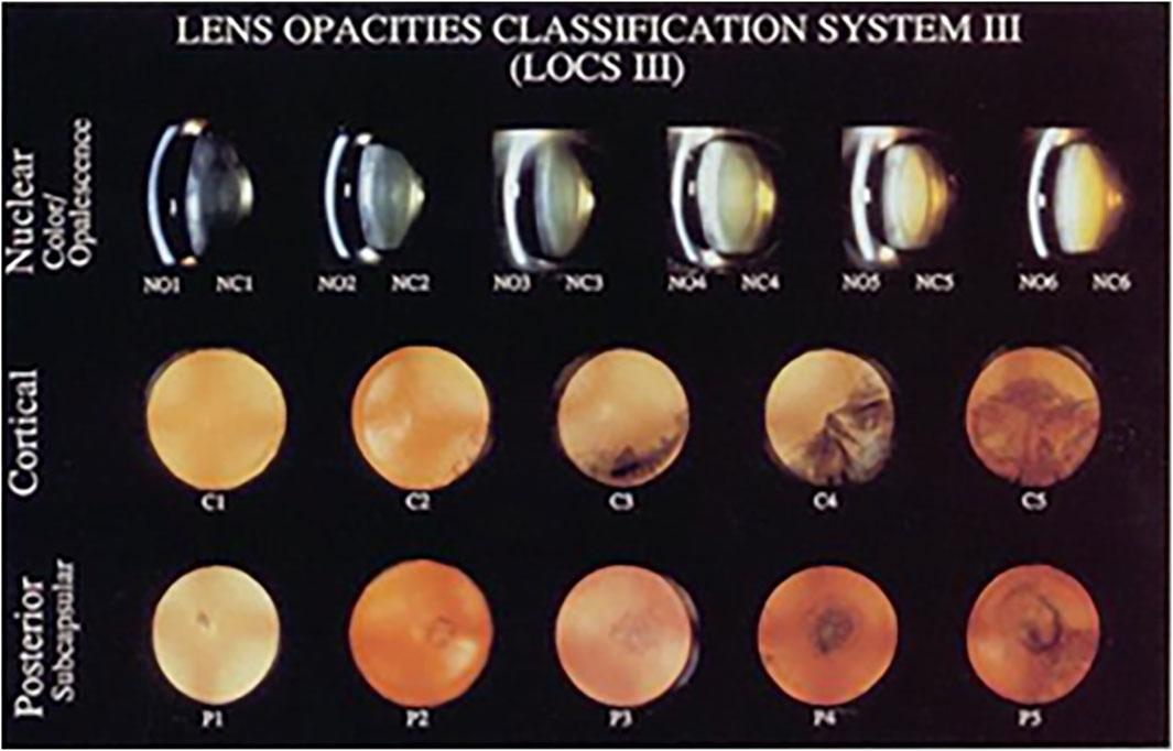 Lens Opacities Classification System III chart shows different stages of lens opacity. The top row depicts nuclear color/opalescence (NO1-NC6), the middle row represents cortical opacities (C1-C5), and the bottom row displays posterior subcapsular opacities (P1-P5). Each section illustrates varying levels of cloudiness or opacities within a lens.