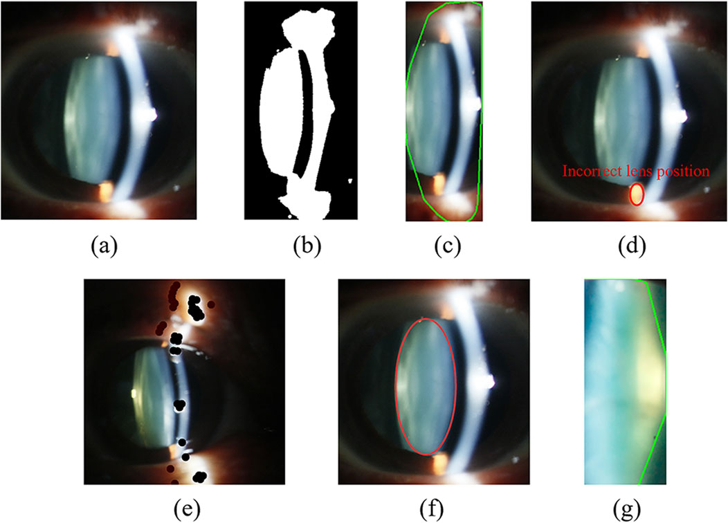 A series of images labeled (a) to (g) showing eye examinations and lens analysis. (a) displays an eye with a visible lens. (b) is a binary mask of the lens structure. (c) and (g) include green outlines to highlight lens positions. (d) has text indicating an incorrect lens position. (e) shows dark spots near the lens. (f) features a red oval encircling the lens area. The images analyze lens position and condition.
