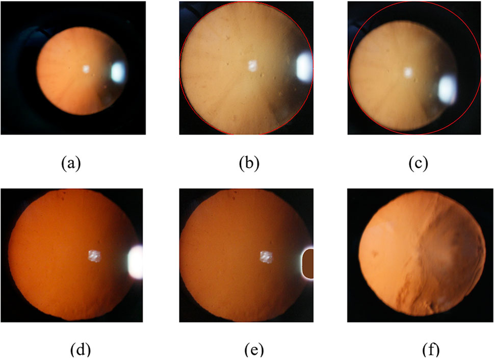 Series of six retinal images labeled (a) to (f), each showing variations in focus, lighting, and clarity. Some images feature reflections and different levels of illumination on the retinal surface.