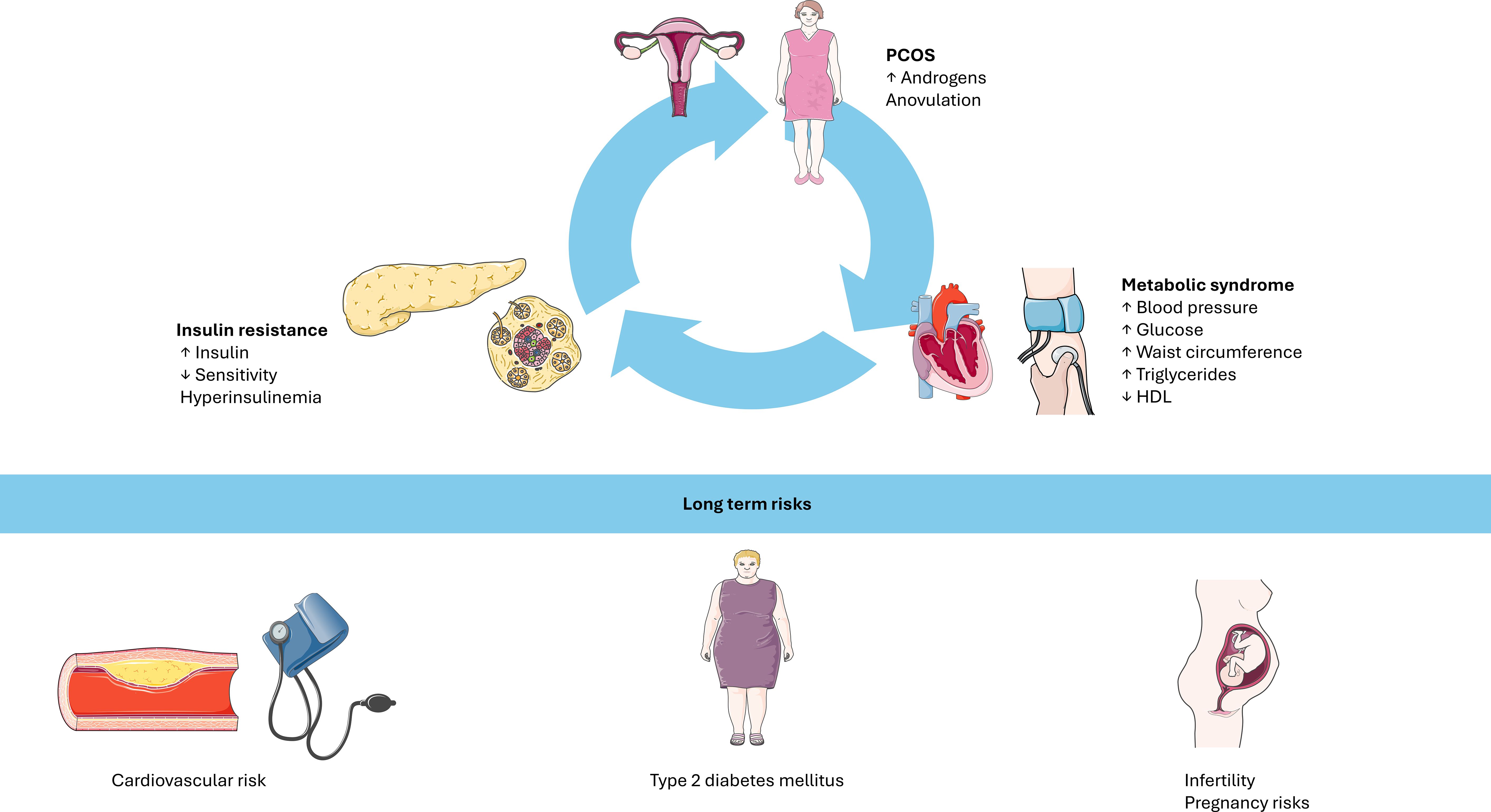 Illustration depicting the relationship between PCOS, insulin resistance, and metabolic syndrome. Arrows form a cycle between PCOS with increased androgens, insulin resistance with increased insulin levels, and metabolic syndrome with high blood pressure. Long-term risks include cardiovascular risk, type 2 diabetes mellitus, and infertility or pregnancy risks.