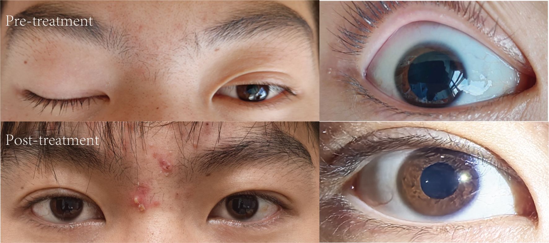 Series of clinical photographs comparing the right eye pre-treatment and post-treatment for oculomotor nerve palsy. Pre-treatment images exhibit significant ptosis (drooping of the upper eyelid) and a dilated pupil. Post-treatment images show a marked improvement, with a reduction in ptosis allowing the eye to open more fully and a return to normal pupil size and reactivity.