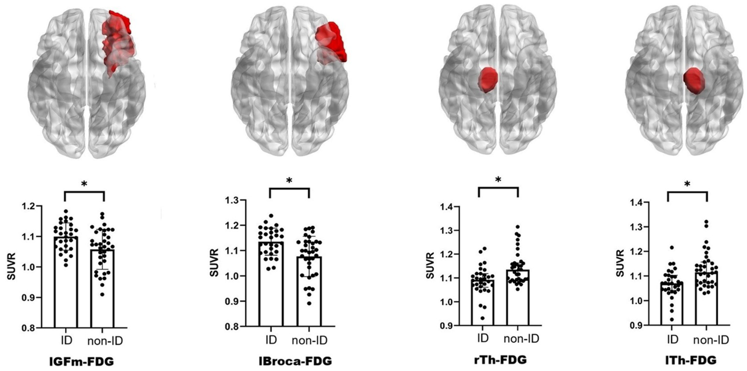 Three brain images show highlighted regions in red, with corresponding bar graphs below. The graphs compare SUVR values for ID and non-ID groups across different brain areas: IGFm, IBroca, and both rTh and lTh. Each graph indicates significant differences between the two groups.