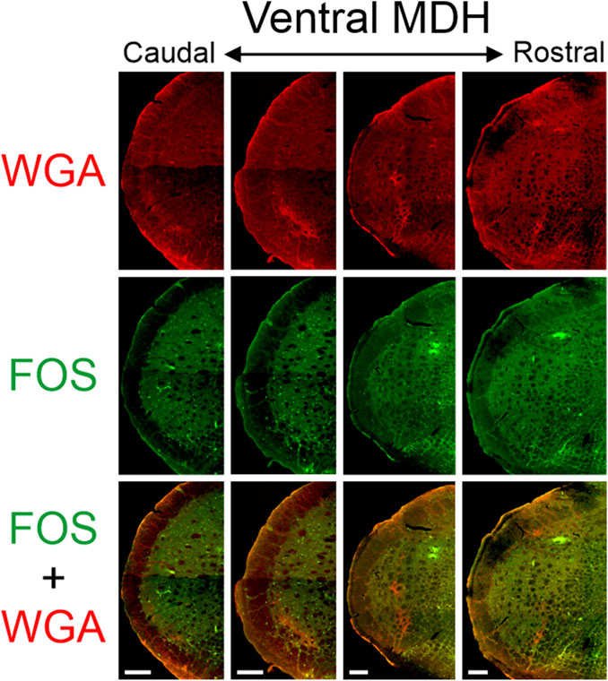 Fluorescence microscopy images showing sections of the ventral medullary dorsal horn (MDH), arranged from caudal to rostral. Top row displays WGA labeling in red. The middle row shows FOS labeling in green. The bottom row combines both labels, with overlapping areas appearing in yellow. Scale bars are present.