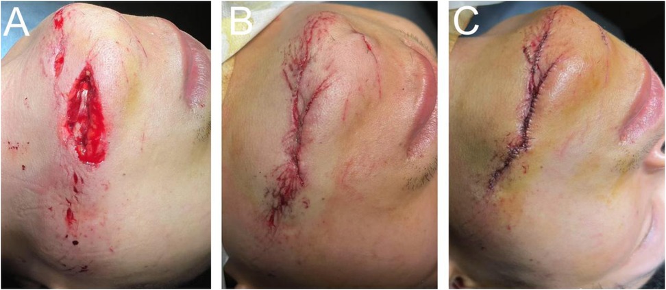 Three-panel comparison image of a facial wound healing process. Panel A shows a fresh, open wound on the cheek. Panel B depicts the wound after stitches have been applied, reducing open exposure. Panel C shows the wound in a more advanced healing stage, with stitches and reduced redness.