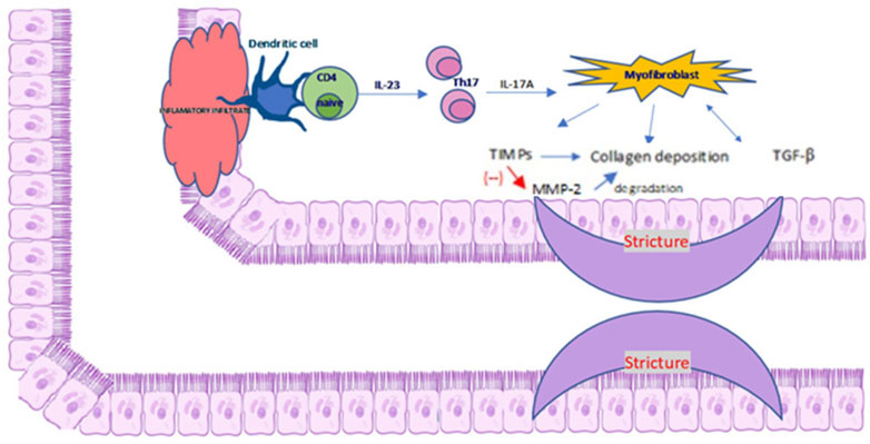 Diagram illustrating the process of intestinal stricture formation. It shows CD4 naïve cells interacting with dendritic cells, leading to the creation of Th17 cells. This releases interleukins IL-23 and IL-17A, activating myofibroblasts, which cause collagen deposition and TGF-beta production. TIMPs inhibit MMP-2 degradation. The resulting inflammation and fibrosis are represented as narrowed segments labeled
