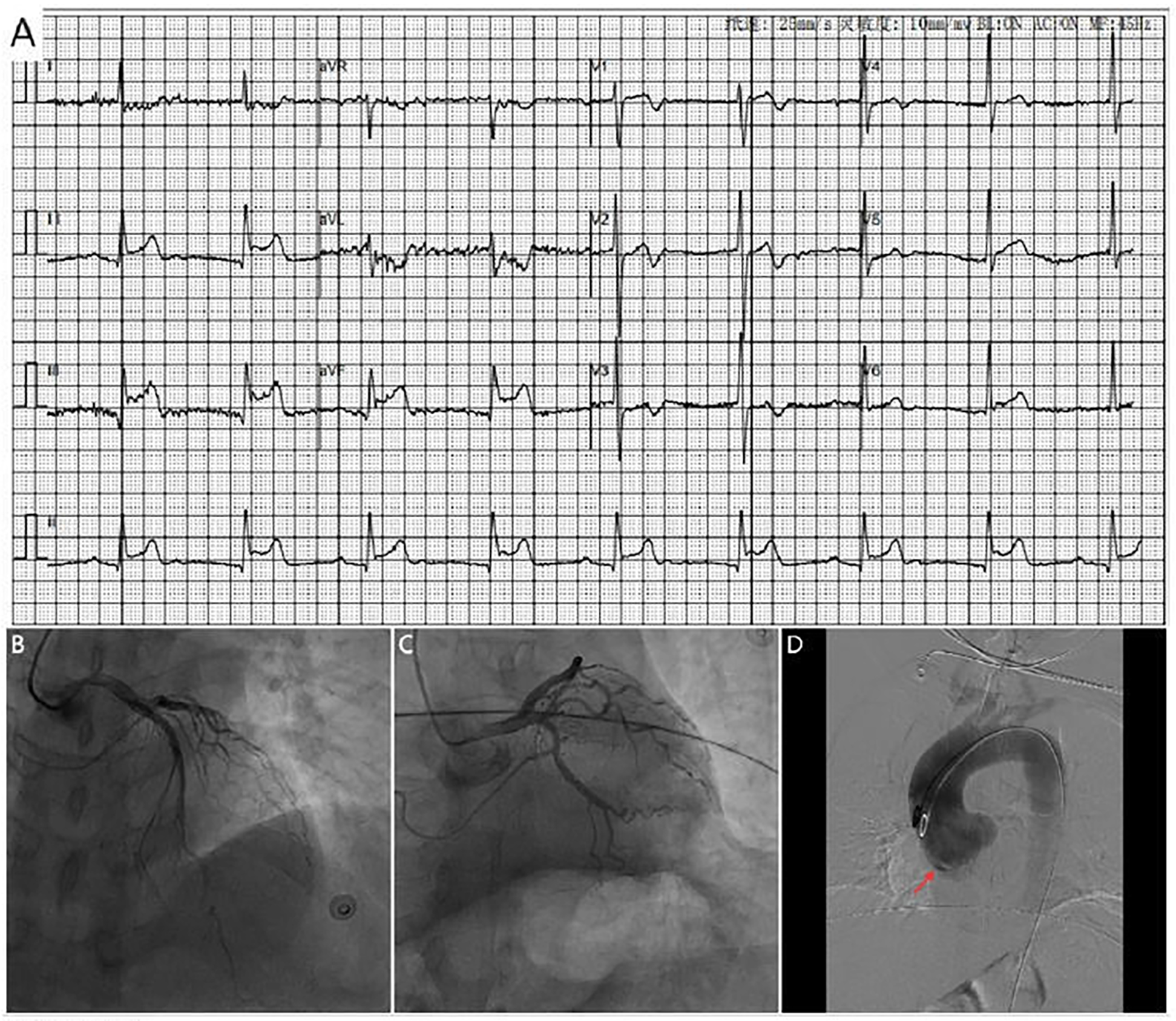Electrocardiogram (ECG) results are shown in grid format, displaying heart electrical activity over multiple leads in panel A. Panels B and C show angiographic images of coronary arteries, highlighting vessel structures. Panel D depicts an arrow indicating a possible area of interest within an aortogram, showing the aorta and surrounding vessels.
