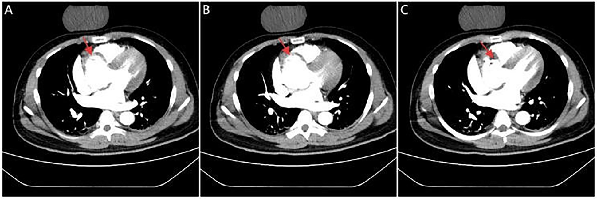 CT scan images in three panels labeled A, B, and C, showing cross-sectional views of the chest. Each panel highlights an area with a red arrow, indicating specific regions of interest within the cardiac structure.