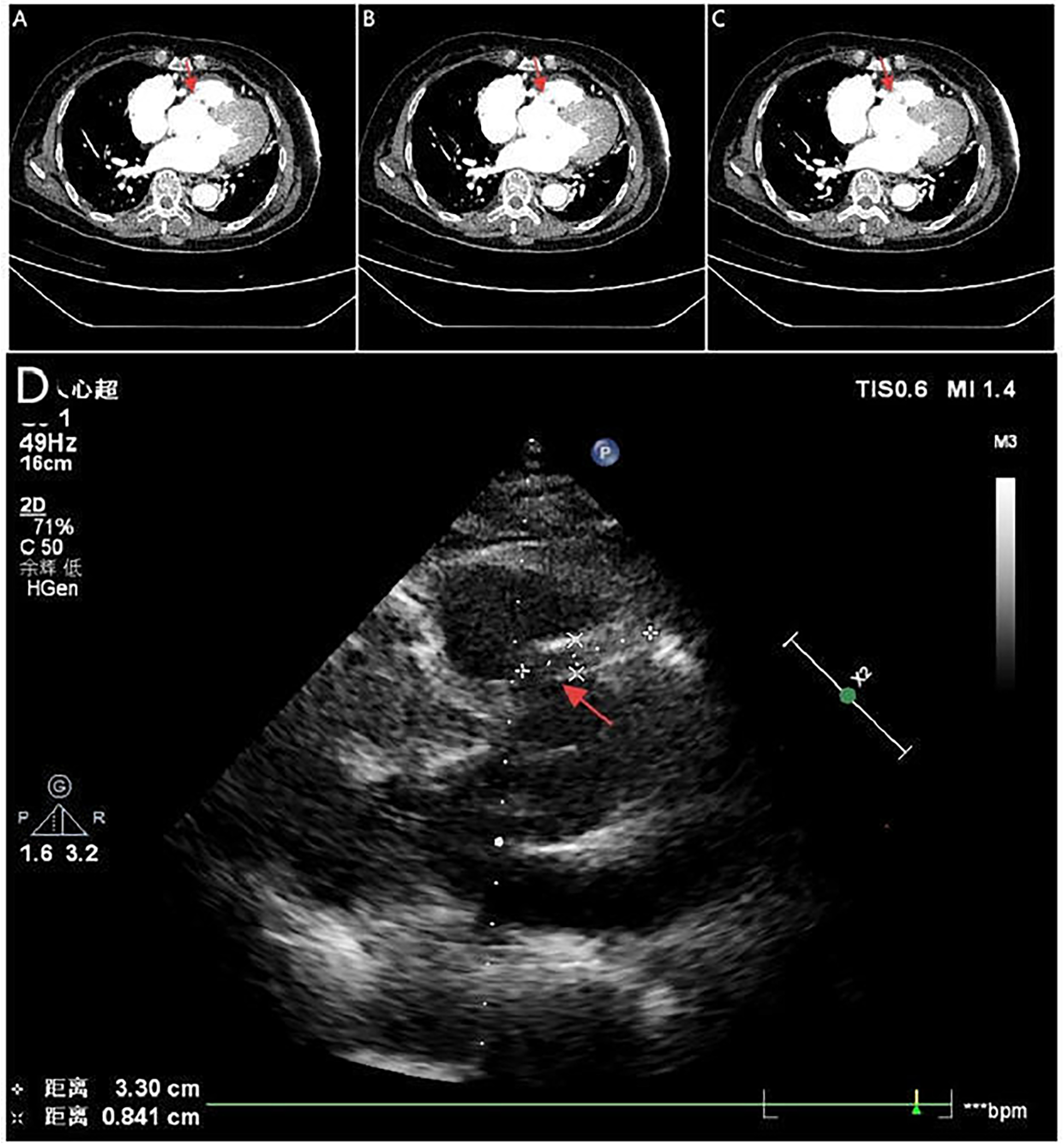 Medical imaging displays three CT scans labeled A, B, and C showing cross-sections of the chest with highlighted areas marked by red arrows. Image D is an ultrasound with a red arrow pointing to a specific region. Measurements and settings are visible on the ultrasound display.