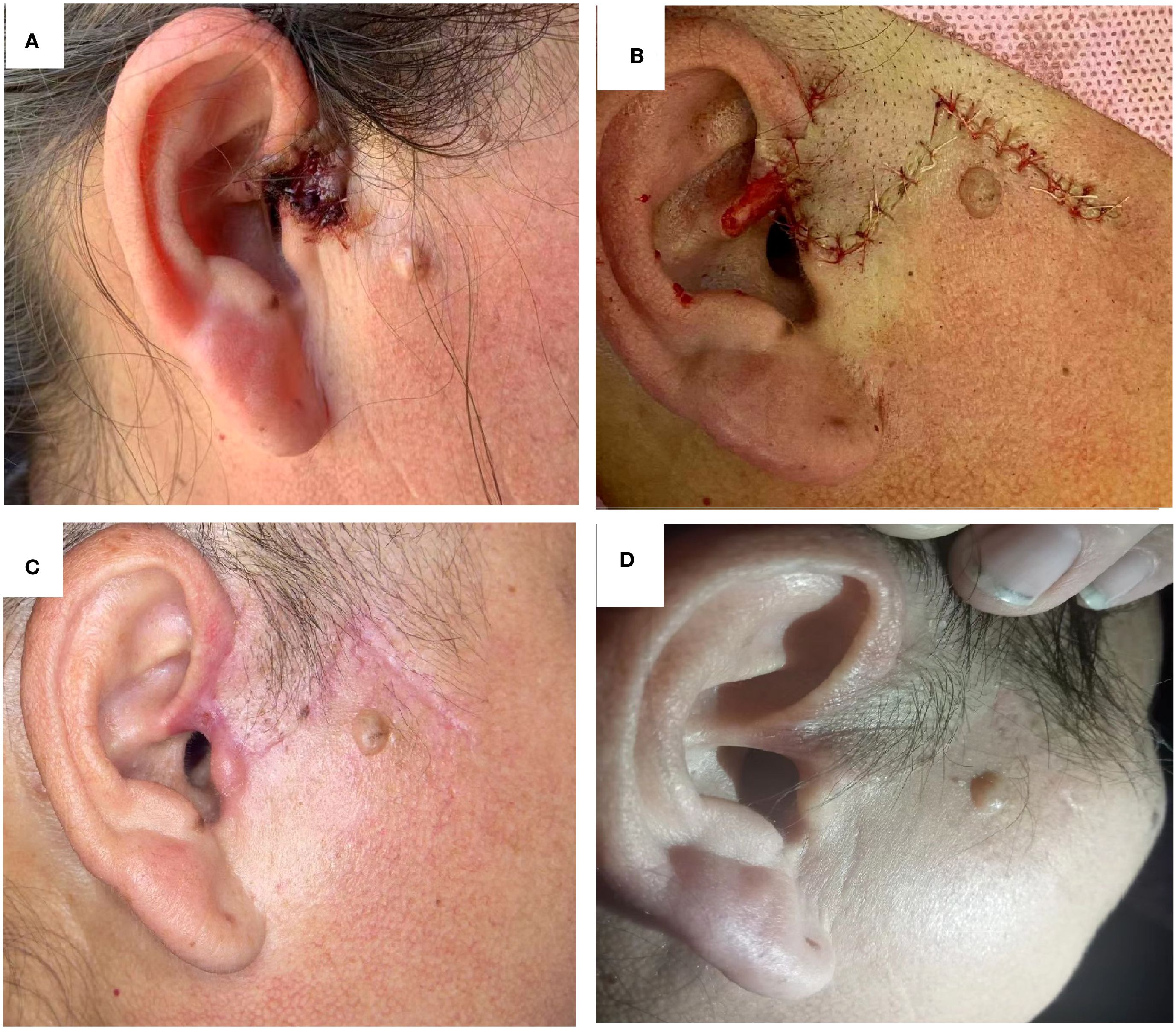 Images A to D show the progression of an ear condition. A: Swollen and discolored lesion on the ear. B: Ear with sutures following a procedure. C: Healed site with scar tissue. D: Ear appears fully healed with normal skin tone.