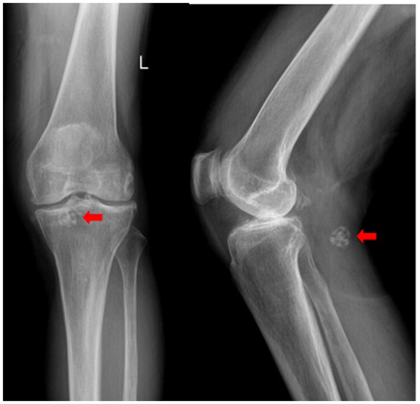 X-ray of a knee joint in two views. Both images have red arrows highlighting a small, round structure near the joint, possibly indicating an abnormality or foreign body. The left side is marked with an