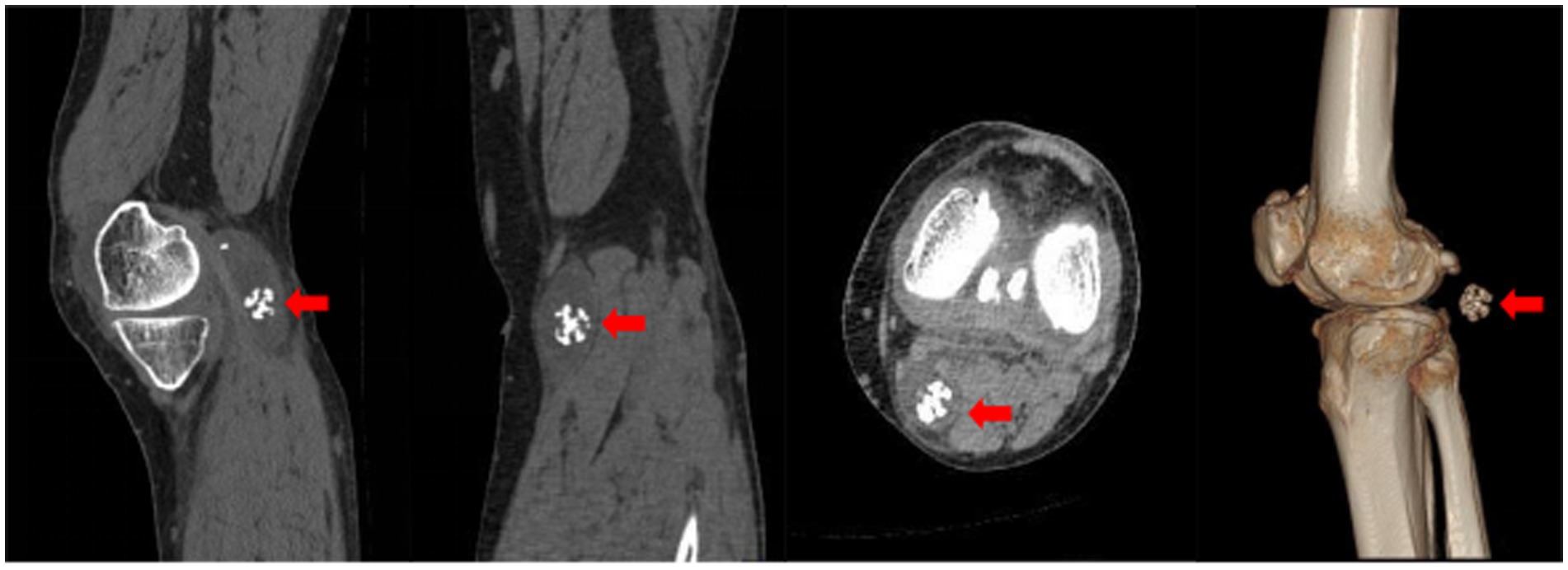 CT images showing a bright white, irregular mass near the knee joint, highlighted by red arrows in different orientations. One image presents a 3D reconstructed view of the knee and mass.