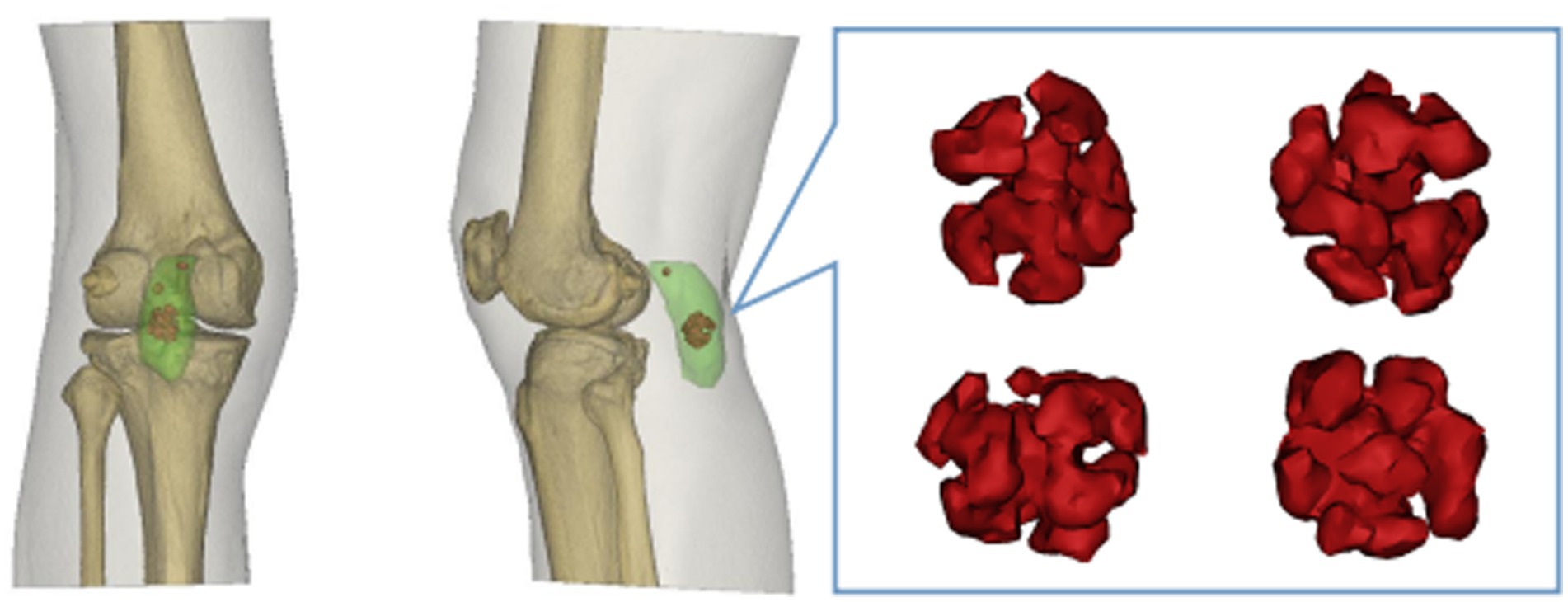 Illustration of a knee joint, displaying bone structure in beige with a green highlighted region on the condyle. Enlarged detail shows clustered red formations, resembling cellular or molecular structures.