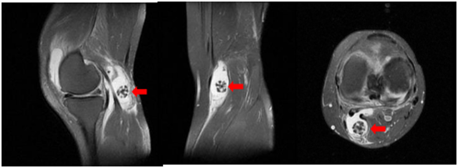MRI scans of a knee, shown in sagittal, coronal, and axial views. The images have red arrows highlighting a circular lesion in the tissue, indicating an area of interest for medical assessment.