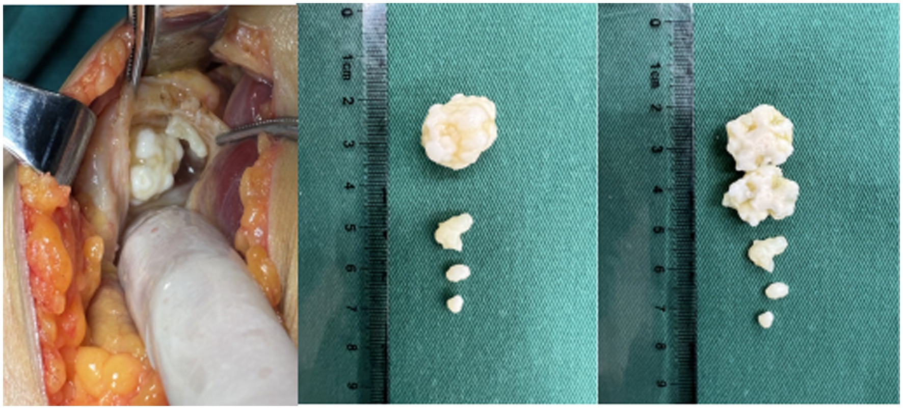 Surgical procedure revealing the removal of several stone-like formations from tissue, displayed next to a ruler for size reference. The image shows two groups of differing sizes placed on a green surgical drape.