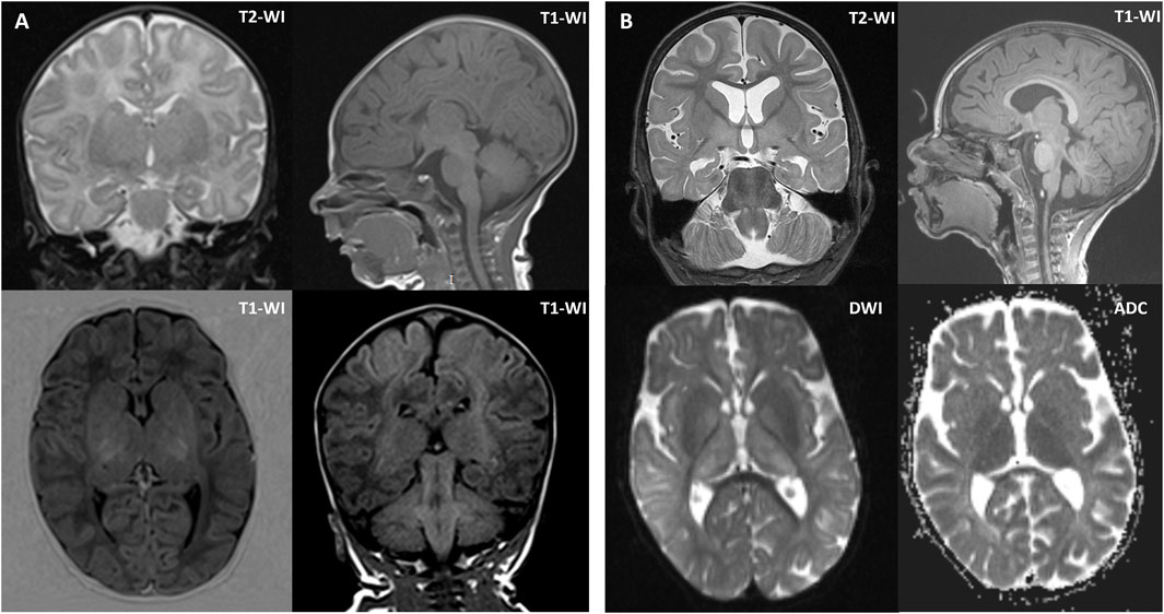 MRI brain images displayed in two panels, A and B. Panel A includes coronal T2-weighted, sagittal T1-weighted, and axial T1-weighted images. Panel B includes coronal T2-weighted, sagittal T1-weighted, diffusion-weighted, and ADC images. Each shows different brain structures and image contrasts.