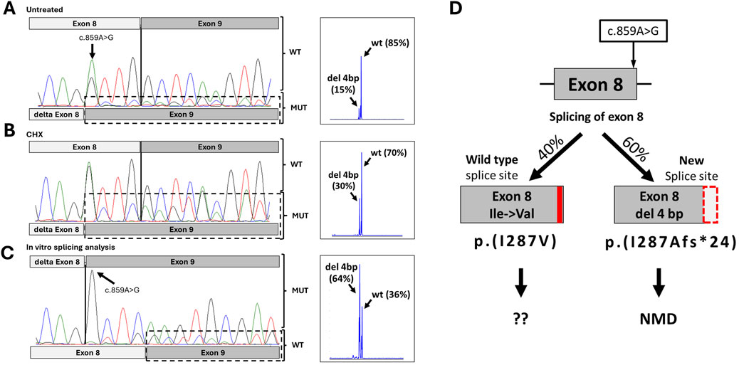 Diagram depicting splicing analysis of exon eight with a c.859A>G mutation. Panels A to C show sequencing results of untreated, CHX treated, and in vitro splicing analysis, respectively, highlighting exon eight deletion. Graphs next to each panel indicate wild type (wt) and mutant (MUT) percentages. Panel D illustrates splicing pathways: wild type and new splice site with 40% and 60% occurrence, respectively, leading to p.(I287V) and p.(I287Afs*24) outcomes. NMD (nonsense-mediated decay) is indicated for the new splice site product.