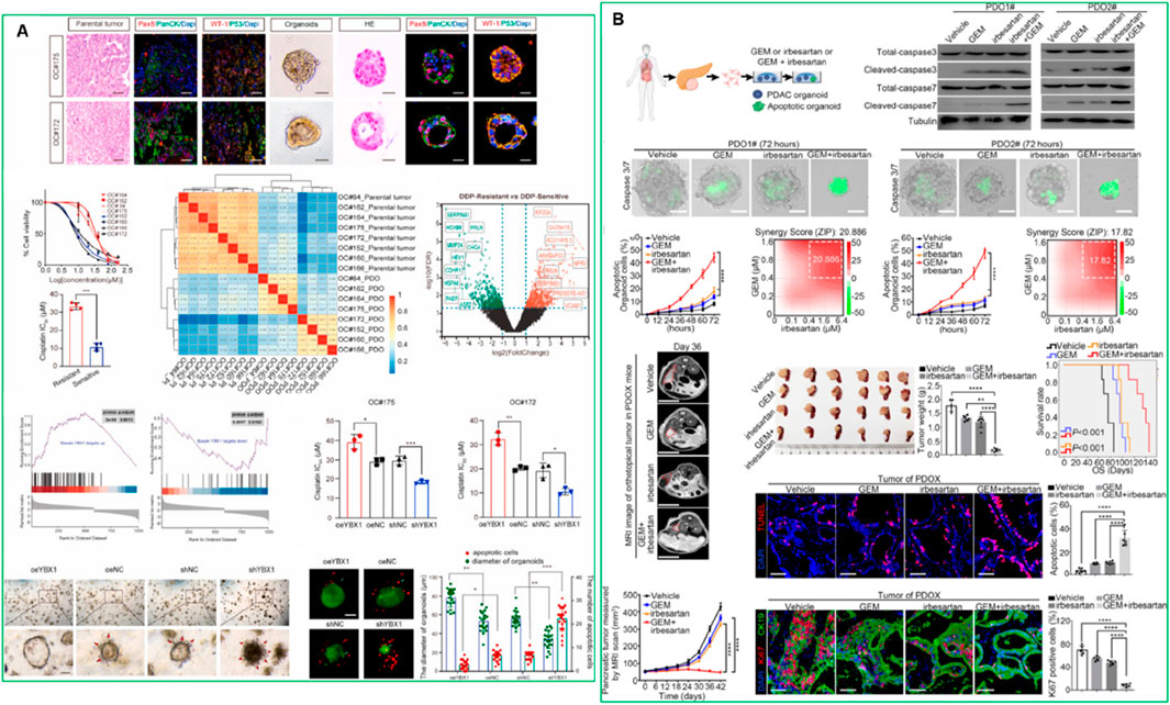 Scientific poster composed of two sections labeled A and B. Section A includes various microscopy images of tumors and organoids, graphs of cell viability, drug sensitivity heatmaps, and gene expression analyses. Section B presents experimental methodologies for drug treatments on organoids, featuring graphs of drug combinations' effectiveness, survival rate analyses, and microscopy results highlighting apoptotic responses. The overall layout emphasizes the comparison of treatment effects on different cell lines.
