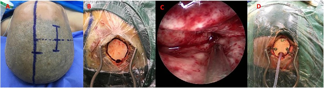 A panel of four medical images labeled A to D. \n\nA: A scalp with surgical markings in blue ink, showing incision guidelines. \n\nB: A close-up of a surgical opening in the scalp with retractors exposing the skull.\n\nC: An endoscopic view of the brain tissue, showing intricate details.\n\nD: A surgical site with a plastic cover and medical tools inserted, secured with small screws.\n\nEach image depicts different stages of a medical procedure.