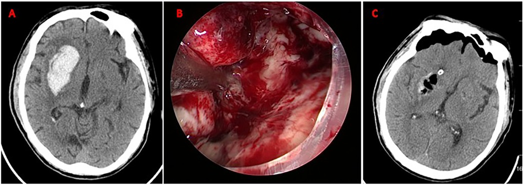 CT scans labeled A and C showing a brain with distinct areas of varying densities, likely indicating a pathology. Image B, centered, is an endoscopic view displaying a closer, detailed look at a lesion or area of interest, with visible red and white tissue.