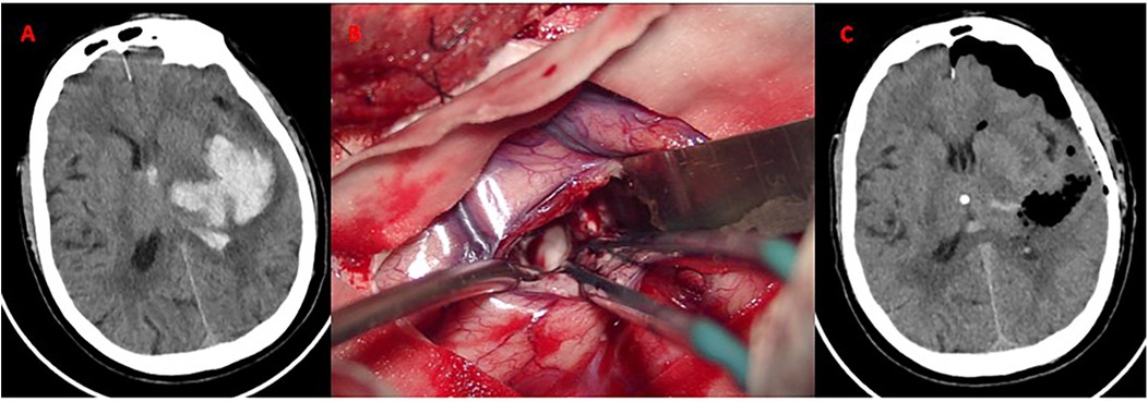 Panel A shows a CT scan of the brain with a bright irregular area indicating hemorrhage. Panel B captures a surgical procedure on brain tissue with visible blood vessels and instruments. Panel C displays a post-operative CT scan with reduced hemorrhage and dark areas indicating possible air or fluid collection.