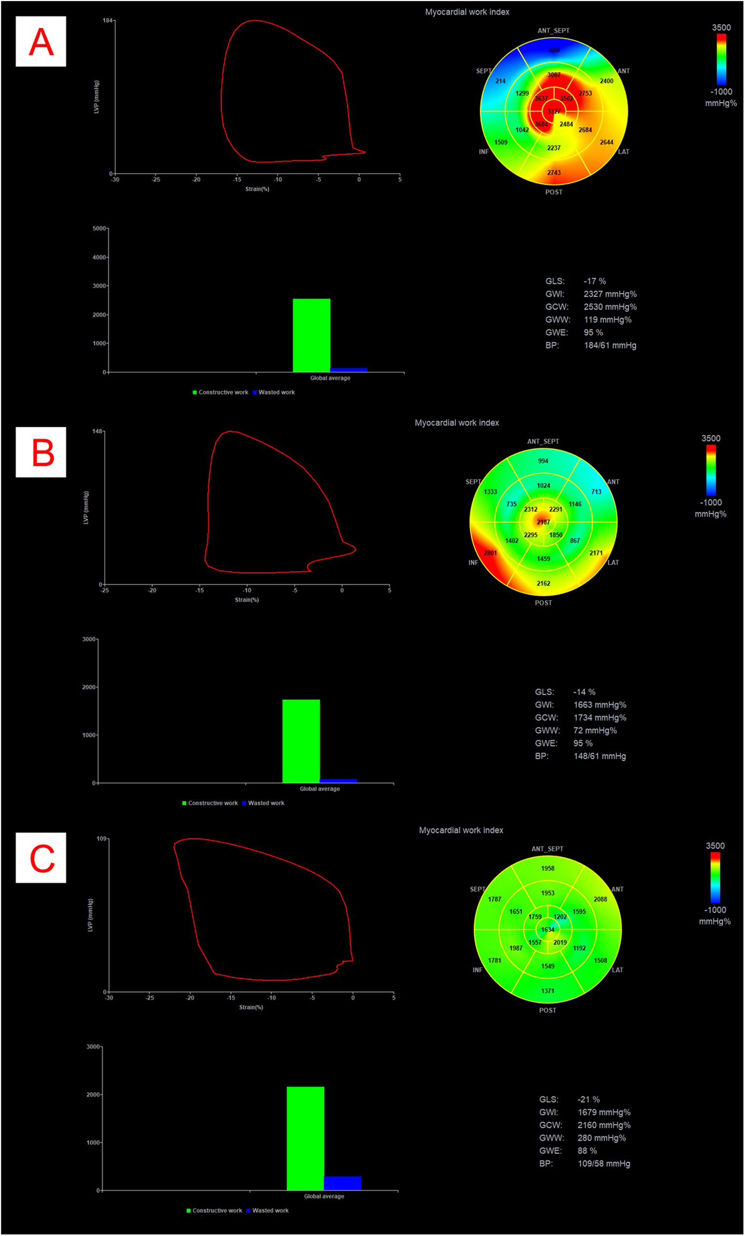 Three panels labeled A, B, and C display myocardial work index data. Each panel includes a LV pressure-strain loop graph, a bar graph showing constructive and wasted work, and a bullseye plot of myocardial performance. Color scales range from -1000 to 3500 mmHg%. Panel A shows higher constructive work and a global longitudinal strain (GLS) of -17%. Panel B depicts moderate constructive work with a GLS of -14%. Panel C indicates an improved condition with a GLS of -21%, minimal wasted work, and more uniform myocardial function across segments.